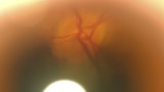 Smartphone Direct Ophthalmoscopy Peripapillary Hemorrhages [upl. by Hjerpe454]