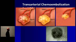 Hepatocellular Carcinoma Optimal Treatment and Transplantation [upl. by Scutt]