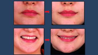 Mouth corner lift Korea plastic surgery [upl. by Amirak891]