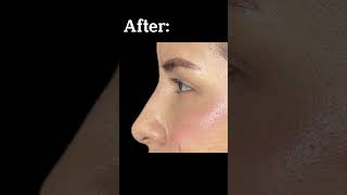 Nonsurgical Nose Job Before and After [upl. by Silvain]