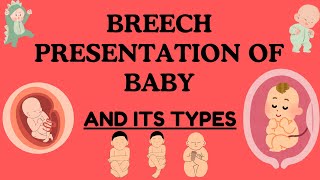 Breech Presentation of Baby Understanding Types Risks and Delivery Options Novice Medic [upl. by Aikemehs]