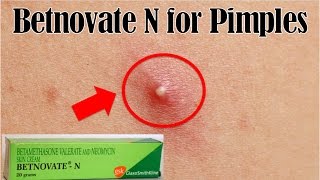 How to use Betnovate N for pimples  Remove pimples overnight remedy [upl. by Ocinom]