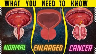 Enlarged Prostate vs Prostate Cancer What You Need to Know [upl. by Rosner]