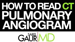 How to Read a CT Pulmonary Angiogram CTPA or PE Study [upl. by Gehman]