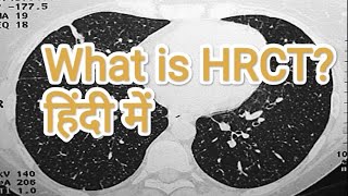 HRCT Thorax details Knowledge।। जानिए HRCT Thorax के बारे में हिन्दी मे।। [upl. by Frazier]