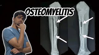 Osteomyelitis  Causes Pathogenesis Complications and Pathophysiology Bone Infection pathology [upl. by Yleve]