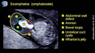 Omphalocele exomphalos [upl. by Justino]