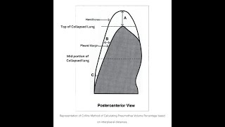 Pneumothorax Percentage Calculator and its importance [upl. by Eveneg57]