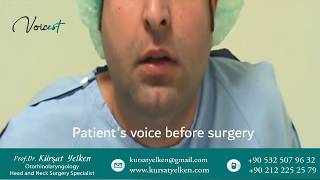 Voice Masculinization Surgery Voice Deepening Surgery [upl. by Llerrot341]