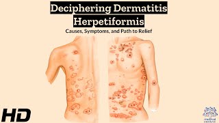 Dermatitis Herpetiformis Explained Symptoms Triggers and Relief [upl. by Ycniuqed]