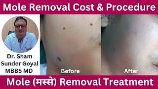 Mole Removal Cost amp Procedure Moles मस्से Removal Treatment [upl. by Ahsiek]