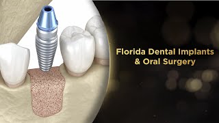 Dental Surgery Animation  Bone Grafting [upl. by Eellah109]