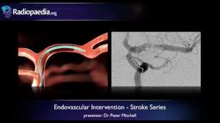 Stroke Endovascular management of ischaemic stroke  radiology video tutorial [upl. by Enilegnave]