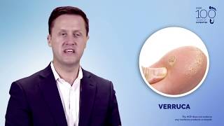 Understand and Manage Wart amp Verruca [upl. by Warfeld]