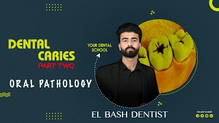 dental caries  part 2  oral pathology  عزت شومان [upl. by Sheeb]