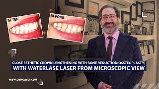 lose esthetic crown lengthening with bone reductionossteoplasty with waterlase laser [upl. by Mukerji632]