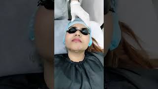 face laser treatmentlasertreatment youtubeshorts ytshortsindia beauty beforeand [upl. by Ja]