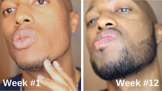 Minoxidil Beard Journey 3 Month Transformation [upl. by Elbart]