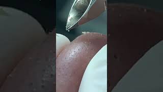 Acne Treatment Mai Ngoc maingoc acne acnetreatments điềutrịmụn shortsvideo [upl. by Akirdna]