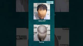 Another DHI™️ Hair Transplant Success Story ❤️️👍 [upl. by Rezeile]