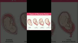 Types of placenta previa implantation  bleeding 🩸knowledge medical shortvideo share [upl. by Leroi251]