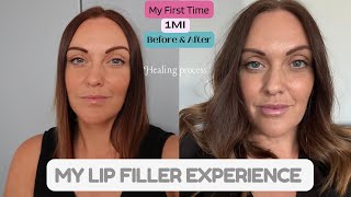 My Lip Filler Experience  What To Expect When Healing  05ml or 1ml [upl. by Jewel]