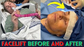 Shocking Facelift Before During amp After Neck Lift  facelift surgery before and after [upl. by Maurilla]