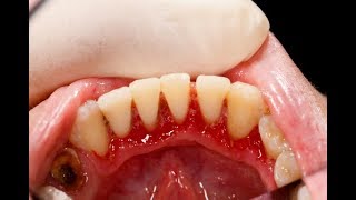 Periodontal Disease Treatment Options with Dr Joe Nemeth amp Dr Tom McCawley [upl. by Yerkovich]