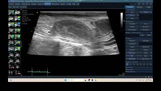 IQ 315 PYOMETRA ULTRASOUND ECHOPAC ANALYSIS UTERUS 2 [upl. by Nnylhtak]