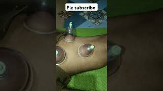 drycupping health pain trending shorts ytvideoindia [upl. by Ewold]