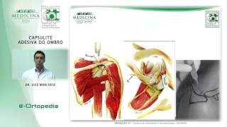 Capsulite Adesiva do Ombro  Dr Luiz Marchese [upl. by Line]