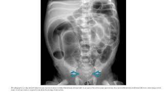 Hirschsprung Disease Imaging [upl. by Meuser747]