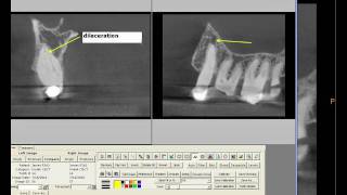 Creating CBCT Reports in TDO Software [upl. by Ibmab]