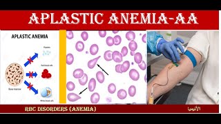 Lecture 161 Aplastic Anemia  AP [upl. by Bloxberg]