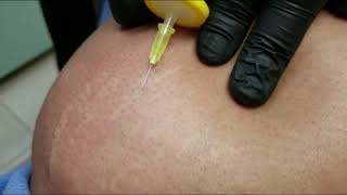 Carboxiterapia para estrias y celulitis [upl. by Atinas]