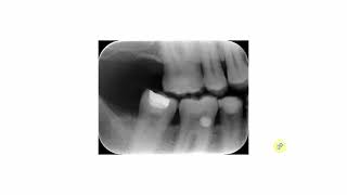 Amalgam versus composite [upl. by Zoe891]