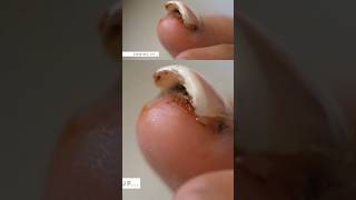 Big Toenail Removal After a Beach Injury 🦶⚕️  Podiatrist’s Guide [upl. by Honeywell]