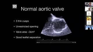 Aortic Stenosis [upl. by Basset]