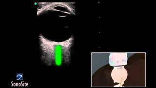 How to Ocular Ultrasound 3D Video [upl. by Erdda562]