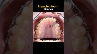 Braces for impacted tooth braces orthodontist dentist dentisty [upl. by Palgrave]