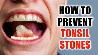 Natural Home Remedies for Tonsil Stones Relief [upl. by Buchalter]