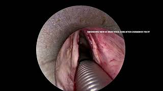 Endoscopic view of vocal cord polyp [upl. by Viridis]