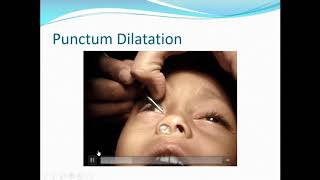 Tackling Nasolacrimal Duct Obstructions  Dr Milind Killedar [upl. by Trixie]