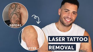 Laser Tattoo Removal  FULL ARM Tattoo Update after 3 treatments [upl. by Jane690]