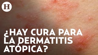 Dermatitis atópica Qué la causa cuáles son los síntomas y qué tratamientos hay  Médico H [upl. by Eniarral]