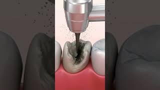 Tooth caries removal dentalcare dentalhygiene caries [upl. by Alenas]