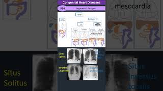 Segmental Analysis Approach to Congenital Heart Diseases [upl. by Aipotu639]