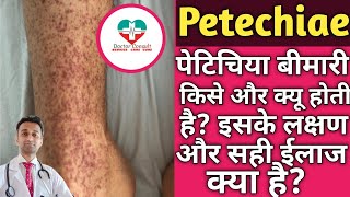 Petechiae। पेतेचीआ बीमारी पूरी तरह कैसे ठीक करे कारण और ईलाज। [upl. by Enilada]