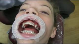 Watch how we put your braces on [upl. by Ahsiele]