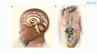 medulloblastoma [upl. by Idnaj29]